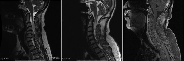 Spinal cord anatomy cross medulla spinalis levels sections sectional length wikidoc physiology different section transverse thoracic level varying prohealthsys